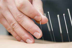 dry-needling